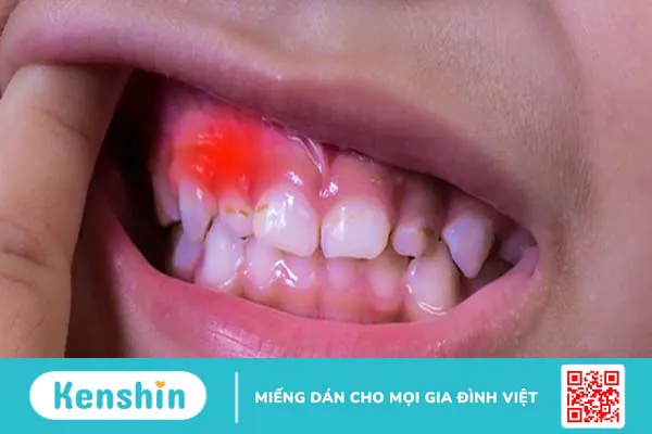 Nguyên nhân nào khiến chân răng bị sưng?