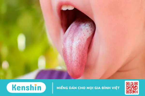 Nguyên nhân nào khiến trẻ bị nấm lưỡi? Triệu chứng, cách phòng ngừa và chăm sóc