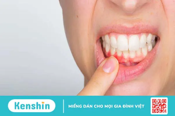 Nguyên nhân nướu răng bị đỏ và cách xử trí