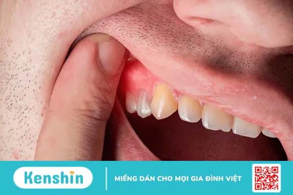 Nướu răng bị đỏ: Nguyên nhân và cách xử trí 1