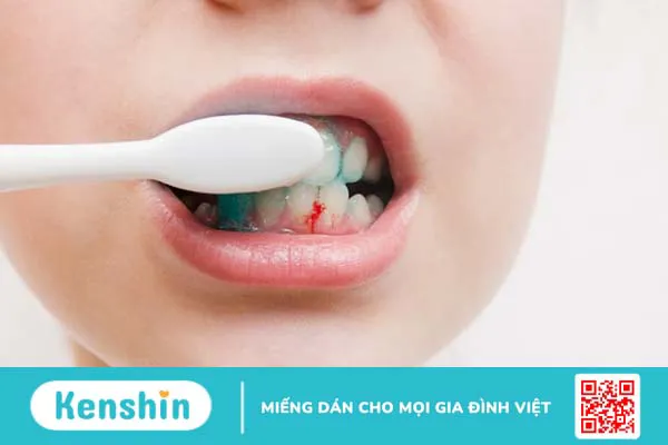 Nướu răng bị đỏ: Nguyên nhân và cách xử trí 4