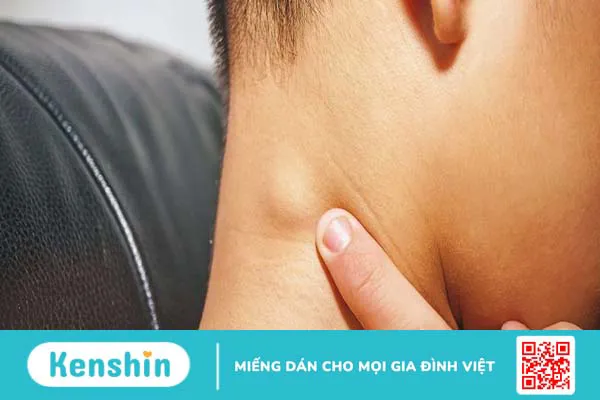 Nguyên nhân u mỡ trên đầu là gì? Cách điều trị bệnh như thế nào?