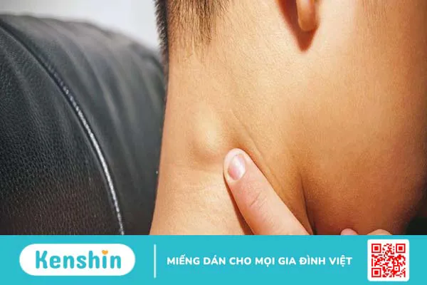 Nguyên nhân u mỡ trên đầu là gì? Cách phòng bệnh? 1