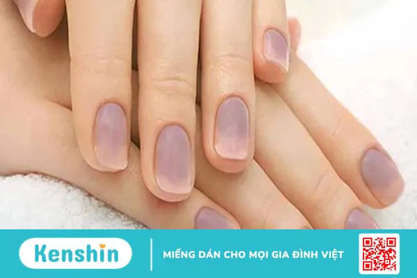 Nguyên nhân và cách khắc phục việc gắn móng giả bị xanh móng