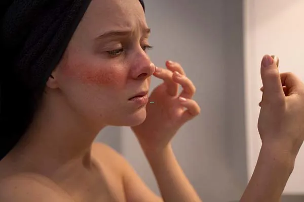 Nguyên nhân và cách phòng tránh căn bệnh rosacea