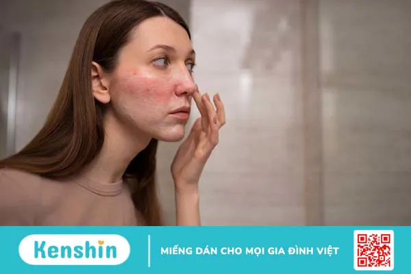 Nguyên nhân và cách phòng tránh căn bệnh rosacea 1