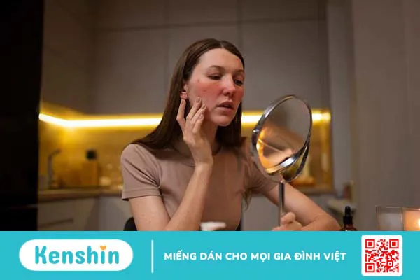 Nguyên nhân và cách phòng tránh căn bệnh rosacea 2