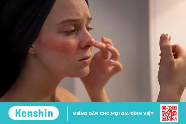 Nguyên nhân và cách phòng tránh căn bệnh rosacea 3