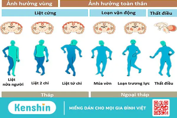 Bại não thể phối hợp: Nguyên nhân, triệu chứng và cách điều trị 1