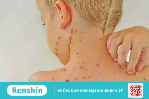 Nhiễm trùng da là gì? Những dạng nhiễm trùng da thường gặp