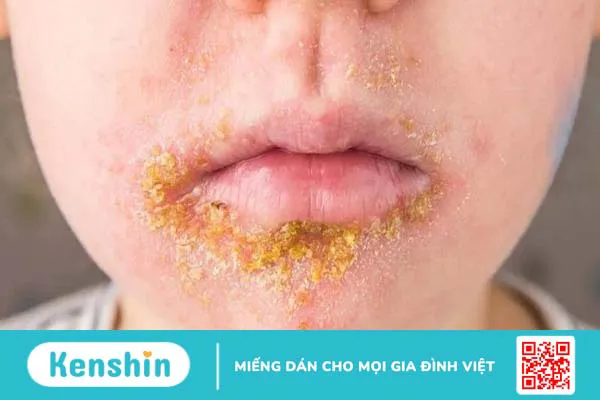 Nhiễm trùng da là gì? Những dạng nhiễm trùng da thường gặp