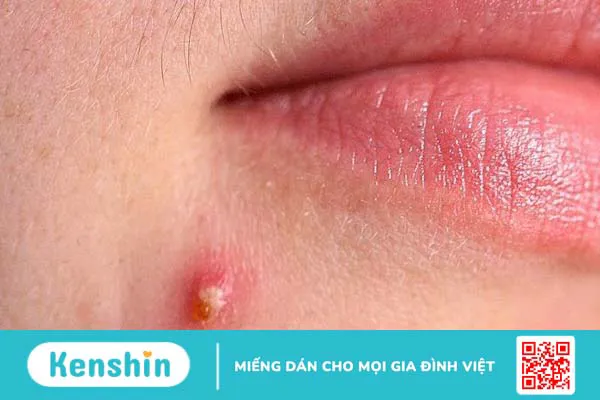 Nhiễm trùng da là gì? Những dạng nhiễm trùng da thường gặp