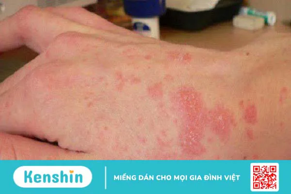 Nhiễm trùng da là gì? Những dạng nhiễm trùng da thường gặp