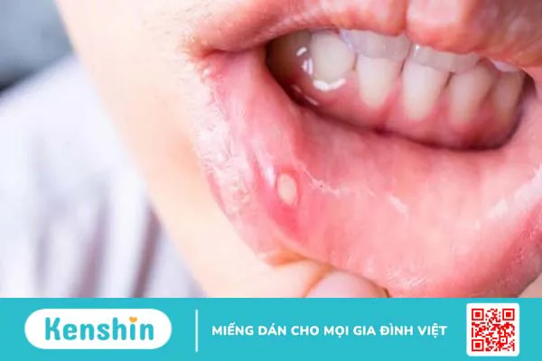 Nhiệt miệng có nguy hiểm không? Hay bị nhiệt miệng là dấu hiệu của bệnh gì?