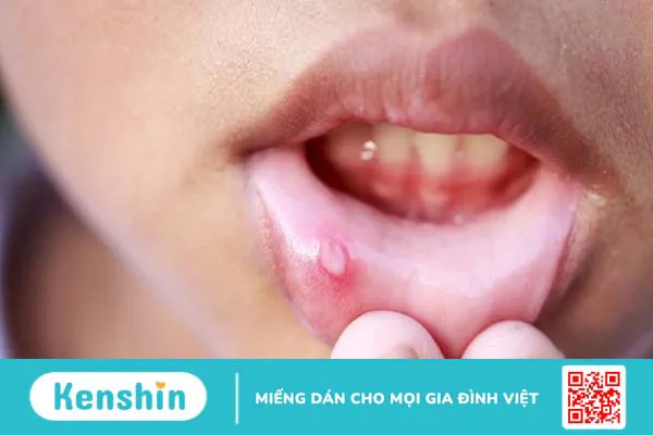 Nhiệt miệng có nguy hiểm không? Hay bị nhiệt miệng là dấu hiệu của bệnh gì? 3