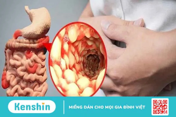 Nhiệt miệng có nguy hiểm không? Hay bị nhiệt miệng là dấu hiệu của bệnh gì? 2