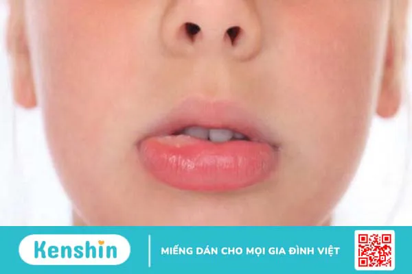 Nhiệt miệng sưng môi là gì? Nguyên nhân và cách điều trị