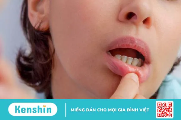 Nhiệt miệng sưng môi là gì? Nguyên nhân và cách điều trị 2