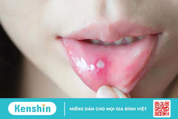 Nhiệt miệng uống nước ép gì giúp mau lành vết loét? 1