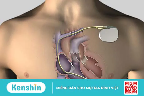 Nhịp chậm xoang: Nguyên nhân, triệu chứng và cách điều trị