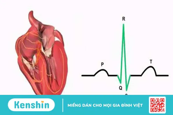 Nhịp xoang là gì? Triệu chứng và điều trị loạn nhịp xoang