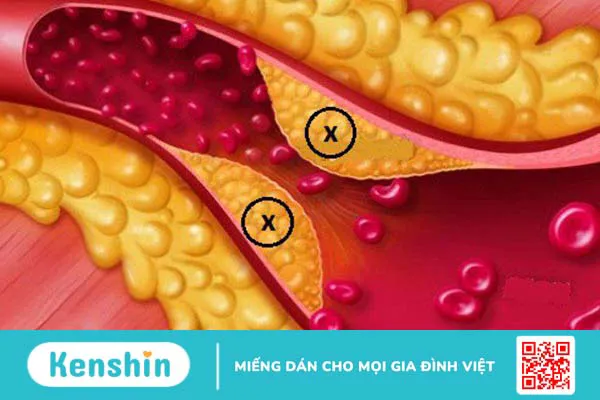 Nhịp xoang là gì? Triệu chứng và điều trị loạn nhịp xoang