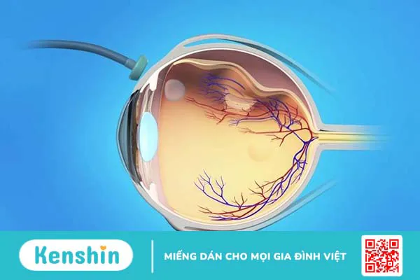 Nhức 1 bên mắt cảnh báo bị bệnh gì?