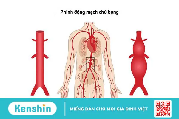 Những đặc điểm của giải phẫu mạch máu ổ bụng