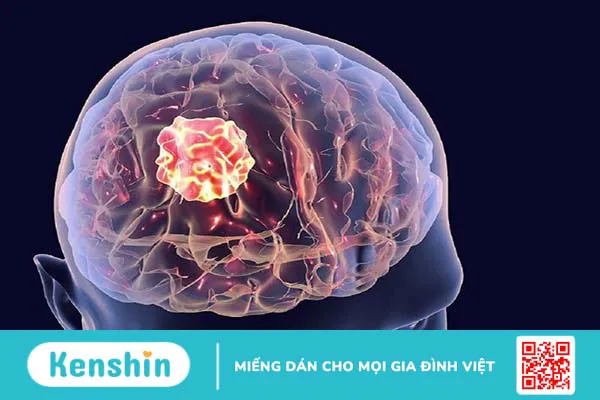 Những dấu hiệu ung thư di căn não và một số phương pháp điều trị