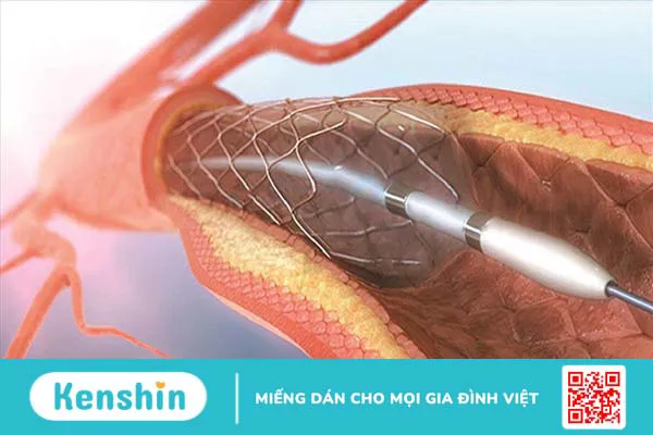 Những điều bạn cần biết về phương pháp chụp động mạch vành qua da 3