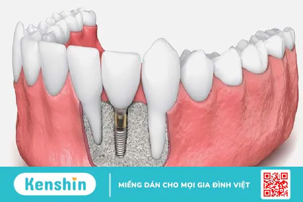 Những điều bạn cần lưu ý khi thực hiện ghép xương tự thân