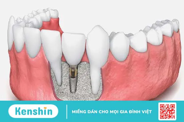 Những điều bạn cần lưu ý khi thực hiện ghép xương tự thân 1