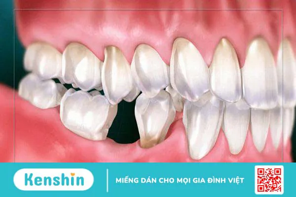 Những điều bạn cần lưu ý khi thực hiện ghép xương tự thân 2