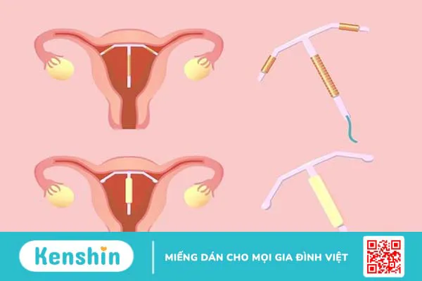 Những điều cần biết trước khi đặt vòng tránh thai 1