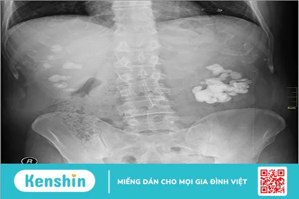 Những điều cần biết và lưu ý khi khám thận 4