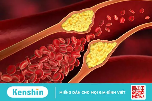 Những điều cần biết về bệnh mỡ máu gia đình