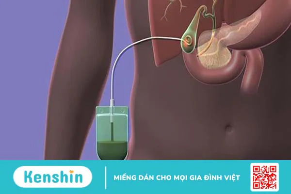 Những điều cần biết về dẫn lưu Kehr sau phẫu thuật lấy sỏi đường mật