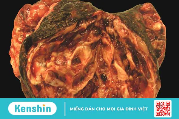 Những điều cần biết về khối u thể Granulosa