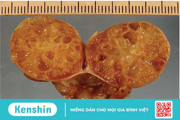 Những điều cần biết về khối u thể granulosa 1