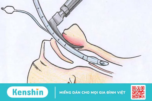 Những điều cần biết về kỹ thuật đặt nội khí quản đường mũi