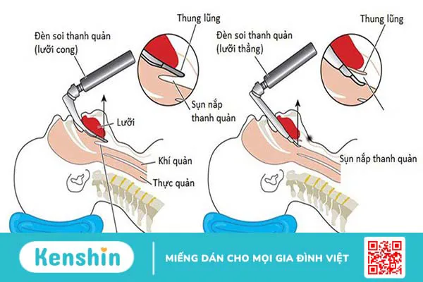 Những điều cần biết về kỹ thuật đặt nội khí quản đường mũi