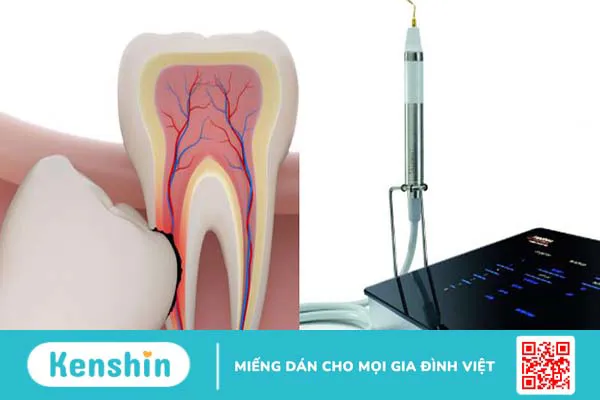 Những điều cần biết về nhổ răng bằng máy siêu âm Piezotome 1