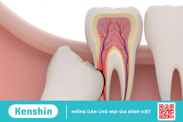 Những điều cần biết về nhổ răng khôn mọc lệch