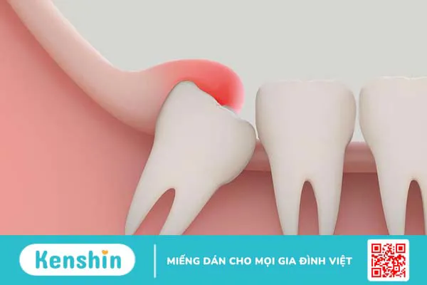 Những điều cần biết về nhổ răng khôn mọc lệch