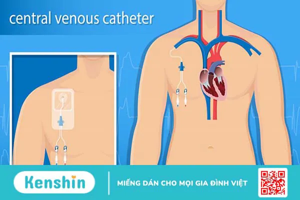 Những điều cần biết về phương pháp đặt catheter tĩnh mạch trung ương