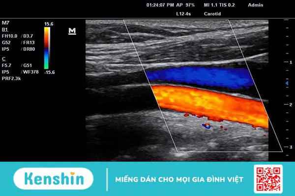 Những điều cần biết về phương pháp đặt catheter tĩnh mạch trung ương