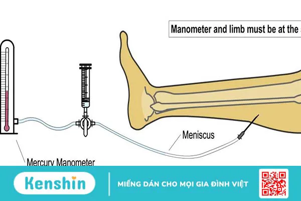 Những điều cần biết về phương pháp Whitesides và hội chứng chèn ép khoang