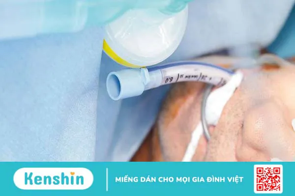 Những điều cần biết về sẹo hẹp khí quản 2