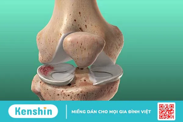 Những điều cần biết về sụn và nguyên nhân gây ra tổn thương sụn thường gặp