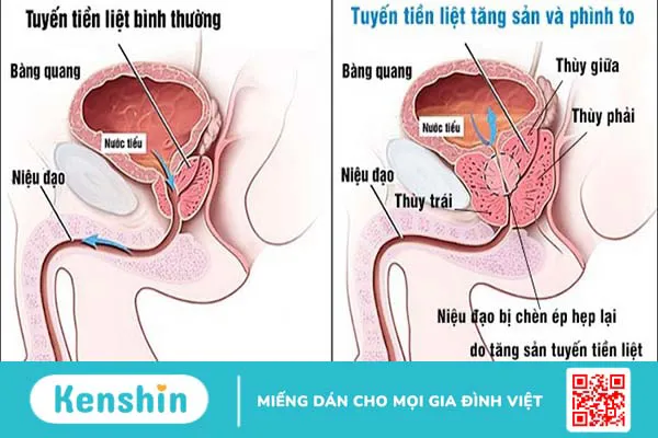 Những điều cần biết về tăng sản lành tính tuyến tiền liệt